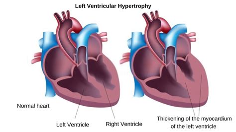 left ventricle thickness measurements|left ventricular hypertrophy symptoms.